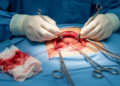Suturing the Posterior Sheath Back May Not Stop Hernia Repair Bulging