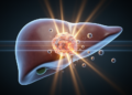 Radiation Before Transplant: Two Bridging Therapies Prove Safe but Imaging Falls Short in Liver Cancer