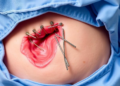 Barbed Sutures Cut Hernia Risk After Keyhole Abdominal Surgery, Study Finds