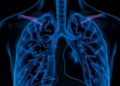 Seven Silent Years: When Bronchiectasis Foreshadows a Deadly Autoimmune Disease