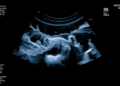 Rethinking Ultrasound After a Child's First Urinary Tract Infection: Radiologists Answer Their Critics