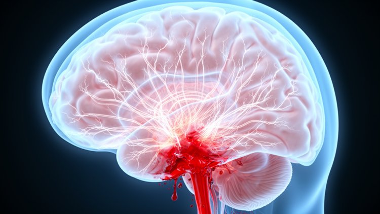 A Runaway Nervous System May Drive Deadly Brain Swelling After Hemorrhagic Stroke