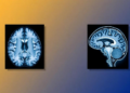 AI Workflow Turns Brain MRI Into CT-Like Images to Sharpen PET Scans