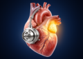The Right Ventricle Emerges as the Achilles' Heel of Mechanical Heart Support