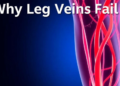 Why Leg Veins Fail: New Review Maps the Hidden Mechanics of Chronic Venous Insufficiency
