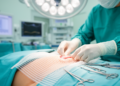 Where Surgeons Place Hernia Mesh May Shape the Risks of Every Future Abdominal Operation