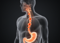 How a 'Low-Risk' Esophageal Cancer Defied the Rules and Struck the Neck Within Months