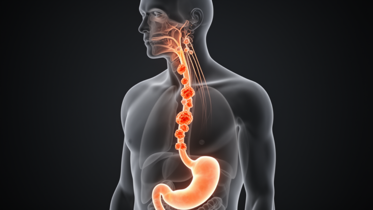 How a 'Low-Risk' Esophageal Cancer Defied the Rules and Struck the Neck Within Months