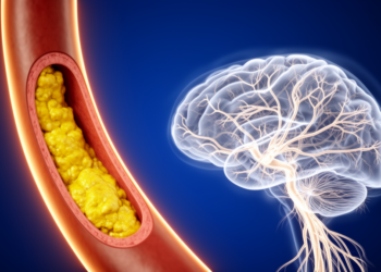 Vulnerable Carotid Plaques Quietly Damage the Brain's White Matter, Study Finds