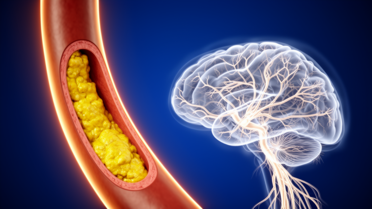 Vulnerable Carotid Plaques Quietly Damage the Brain's White Matter, Study Finds