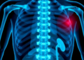 Bone Metastases Drive Rapid Muscle Wasting and Poorer Survival in Kidney Cancer