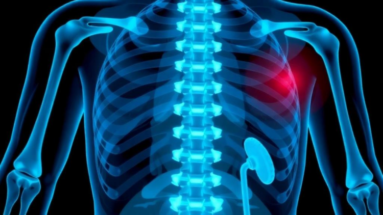 Bone Metastases Drive Rapid Muscle Wasting and Poorer Survival in Kidney Cancer
