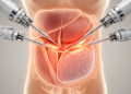 Robotic hernia repair stretches abdominal wall shut without cutting muscle