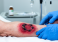 Cancer Drug Cabozantinib Linked to Rare Flesh-Eating Bacteria Mimic