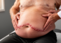 Abdominal pseudohernia preceding the herpes rash: a pre-eruptive diagnostic pitfall in herpes zoster