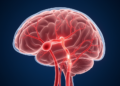 Aneurysm Location May Not Explain the Link Between Brain Bleeds and Vasospasm, Researchers Argue
