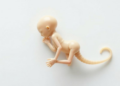 How a Forgotten Meaning of Ileus Shaped the Discovery of Meconium Ileus