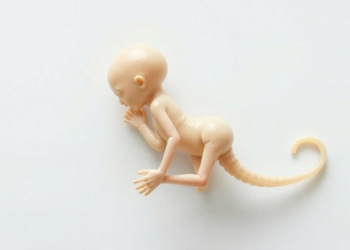 How a Forgotten Meaning of Ileus Shaped the Discovery of Meconium Ileus