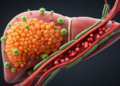 Scientists Map the Cellular Ecosystem That Drives Liver Cancer Spread Through Blood Vessels