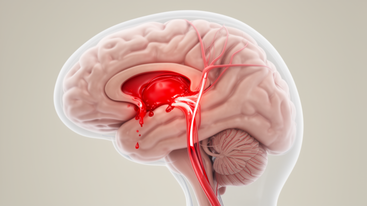 When a Brain Bleed and Vasospasm Collide: New Study Questions the Link