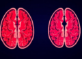 Simple Admission Data Struggle to Predict Stroke Deterioration After Clot Removal
