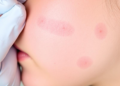 Rare Genetic Syndrome Case Shows Skin Drug Dupilumab Clears Stubborn Eczema