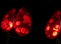 Glowing Tumors: Radionuclide Imaging Spots Positive Margins During Breast Surgery