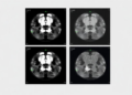 Transformer AI Reconstructs Sharp CT Scans From a Fraction of the Radiation Dose