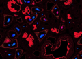 TRK Protein Staining in Childhood Rhabdomyosarcoma Flags Aggressive Tumors but Misses the Gene Fusions That Matter