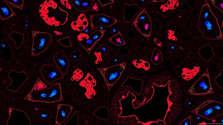 TRK Protein Staining in Childhood Rhabdomyosarcoma Flags Aggressive Tumors but Misses the Gene Fusions That Matter