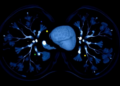 Early PET/CT Scan Predicts Which HER2-Positive Breast Cancers Will Vanish Before Surgery