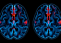 Late Preterm Birth Leaves Subtle Traces in the Adolescent Brain, Landmark Imaging Study Finds