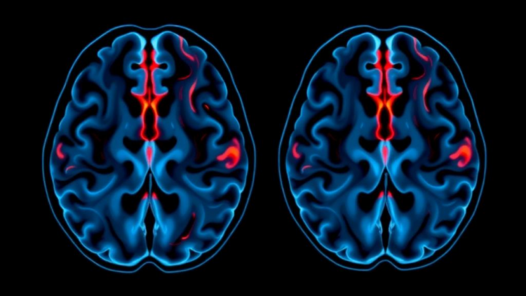 Late Preterm Birth Leaves Subtle Traces in the Adolescent Brain, Landmark Imaging Study Finds