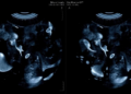 AI Grades Ultrasound Image Quality With 95% Accuracy in Breast Cancer Screening