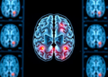AI Ensemble Reads Brain Scans With 98.5% Accuracy and Shows Its Work
