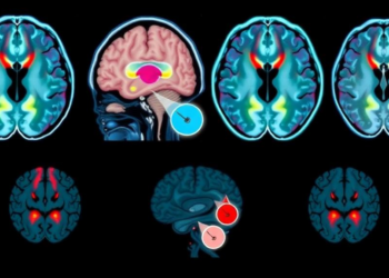 Hybrid AI reads brain scans to stage Alzheimer's disease in four steps