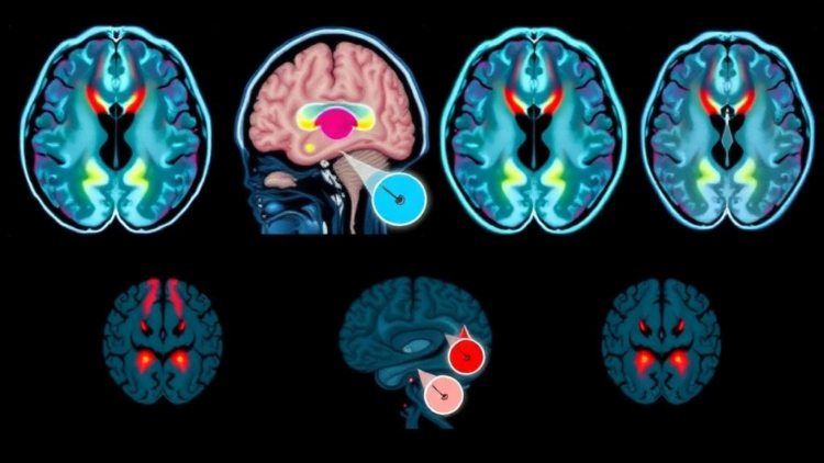Hybrid AI reads brain scans to stage Alzheimer's disease in four steps