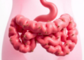 Gut Microbes Take Center Stage in the Renamed Ovarian Syndrome PMOS