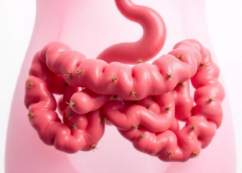 Gut Microbes Take Center Stage in the Renamed Ovarian Syndrome PMOS