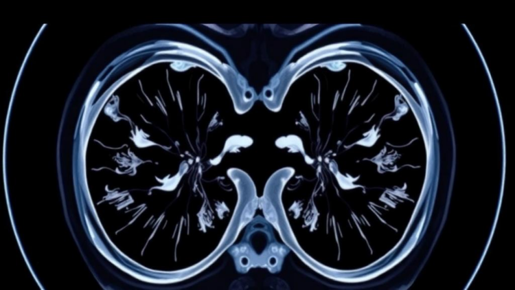 Micro-CT emerges as a promising tool for real-time breast cancer margin checks