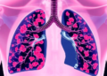 Hungary's Decade of Data Reveals the Harsh Reality of Extensive-Stage Small Cell Lung Cancer