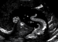 Bladder Debris on Ultrasound in Children: A Clue, Not a Diagnosis, for Urinary Tract Infection