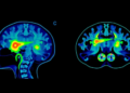 Stimulated Raman Imaging Maps Hidden Bone Damage Around Cancer Metastases