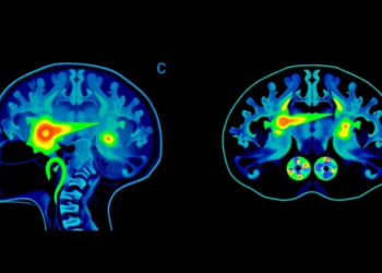 Stimulated Raman Imaging Maps Hidden Bone Damage Around Cancer Metastases