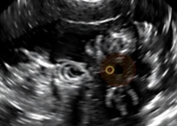 Benign-Looking Ultrasound Features May Hint at Aggressive Triple-Negative Breast Cancer
