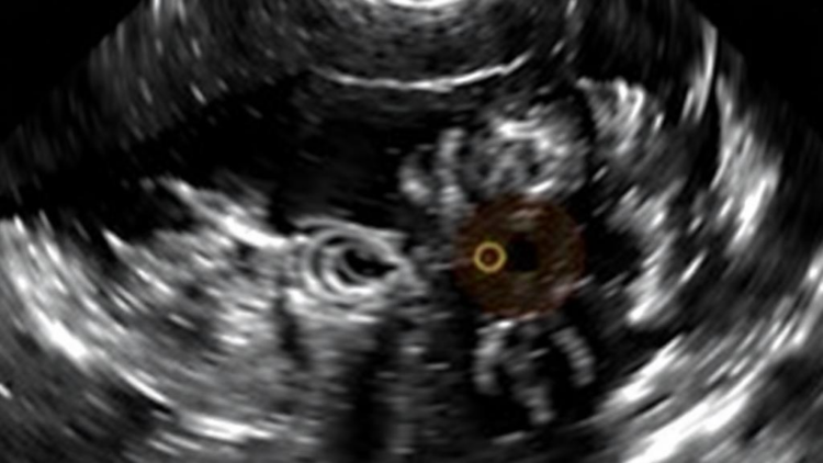 Benign-Looking Ultrasound Features May Hint at Aggressive Triple-Negative Breast Cancer