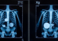 Ultrasound Bone Age Test Matches X-Rays Without Radiation in Children