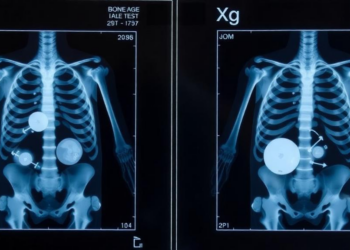 Ultrasound Bone Age Test Matches X-Rays Without Radiation in Children