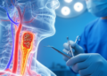 Carotid near occlusion is common on CTA and linked to hyperperfusion risk after carotid surgery