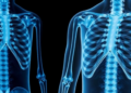 Parathyroid Hormone Runs Low in Diabetic Patients With Osteoporosis, Study Finds